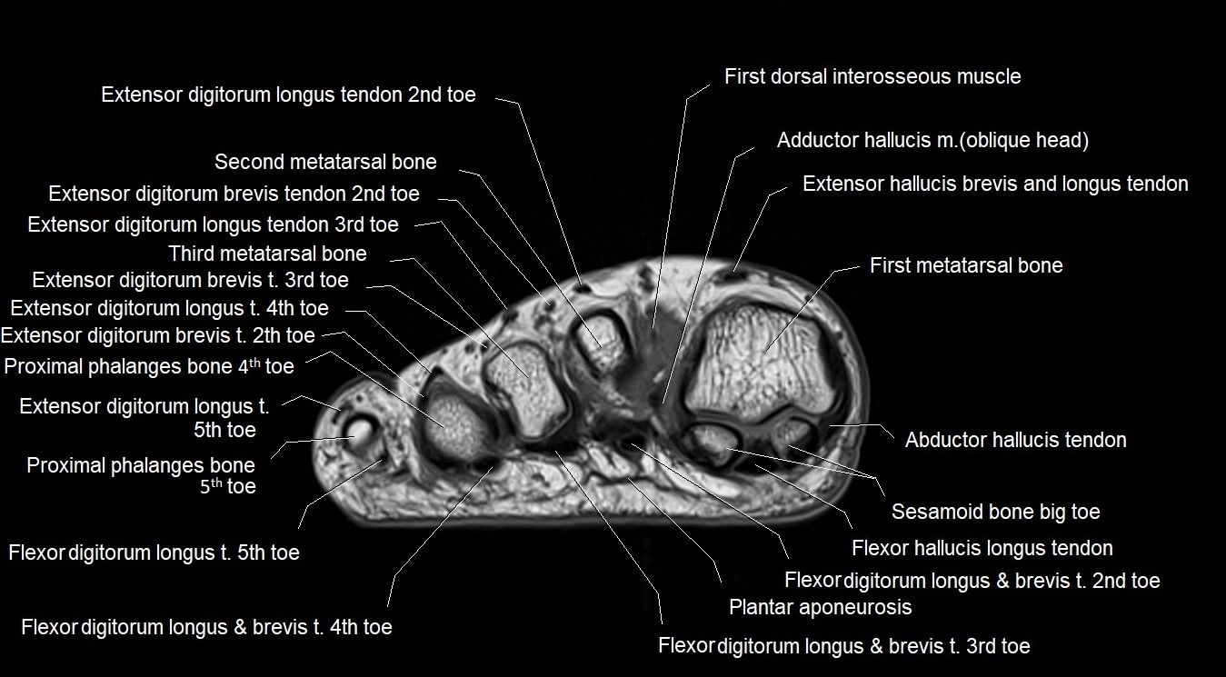 MRI 3T foot axial cross sectional anatomy image 26.webp